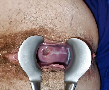 He used a speculum to open my vagina and a Pinpoint vibrator to massage my clitoris and penetrate my cervix.